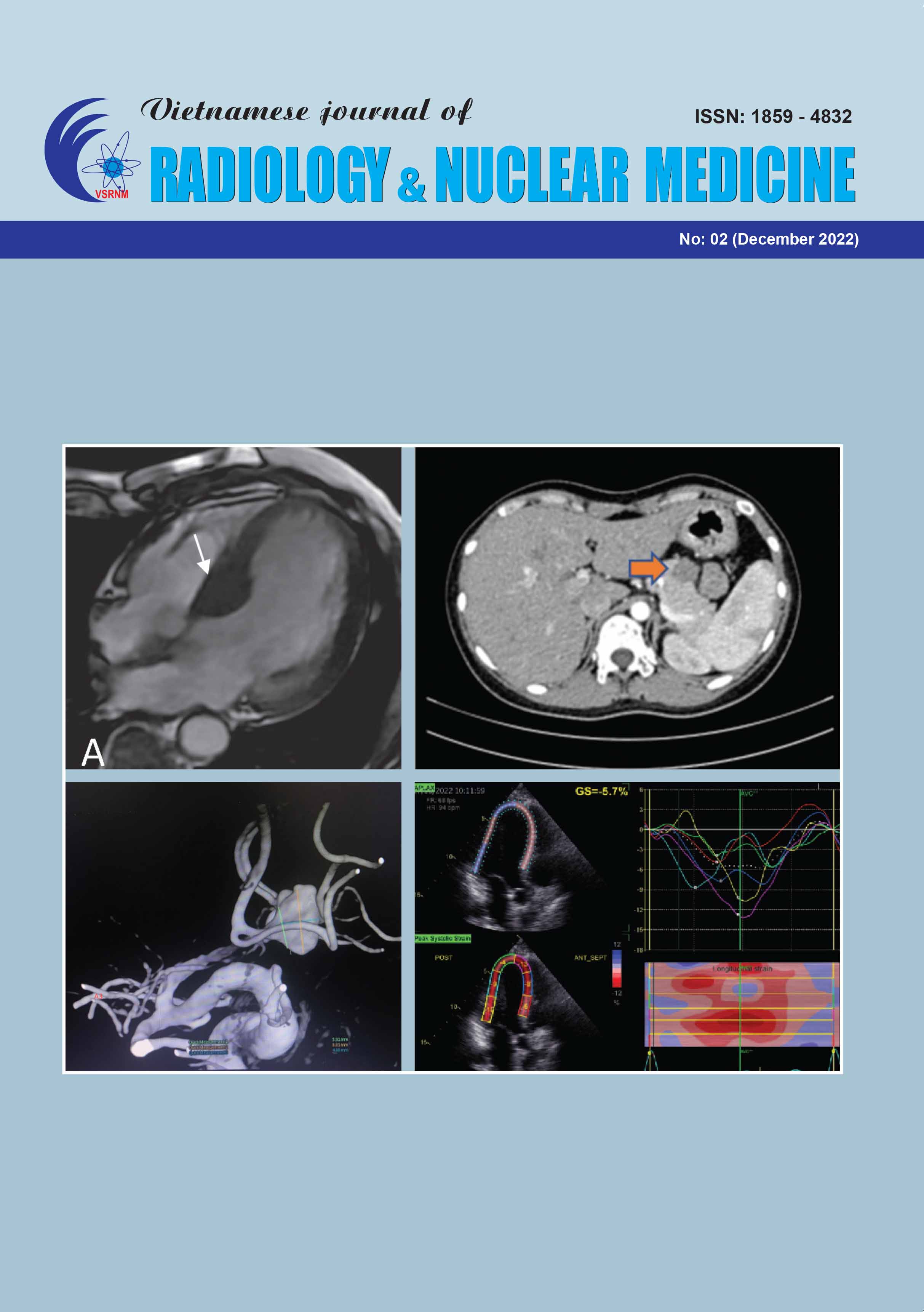 Global Longitudinal Strain to Predict Mortality in Patients With